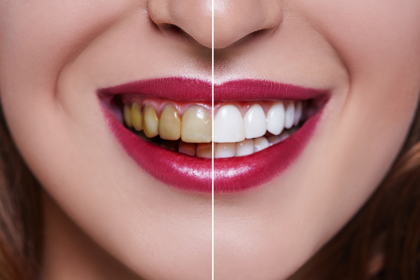 Woman Teeth before and after dental treatment. Teeth Whitening. Happy smiling woman. Dental health Concept. Oral Care, teeth restoration. Bad teeth.